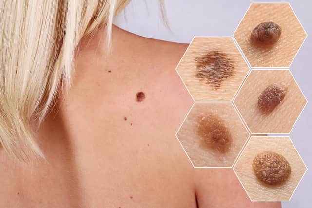 0-Melanoma-cutaneo-ninos-
