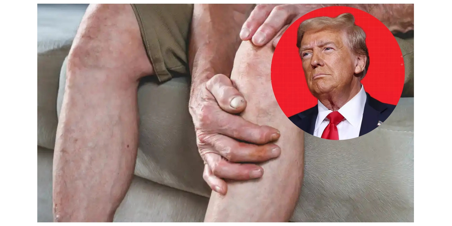 ¿Qué hay en República Dominicana de la enfermedad diagnosticada a Trump?