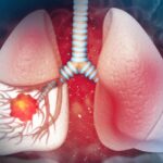 Cáncer de pulmón