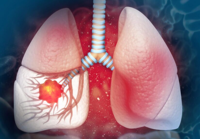 Cáncer de pulmón