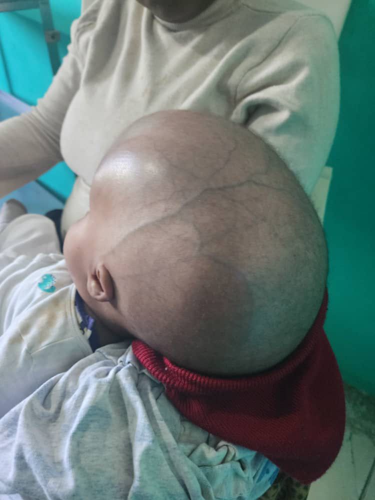 Cruz Jiminián y Hospital Buen El Samaritano inician jornada de cirugías hidrocefalia