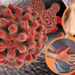 hepatitis