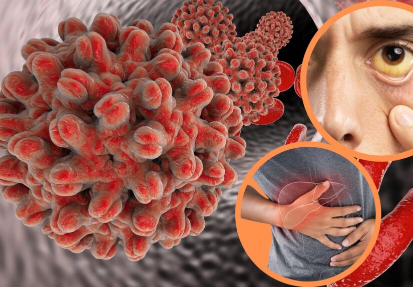 hepatitis