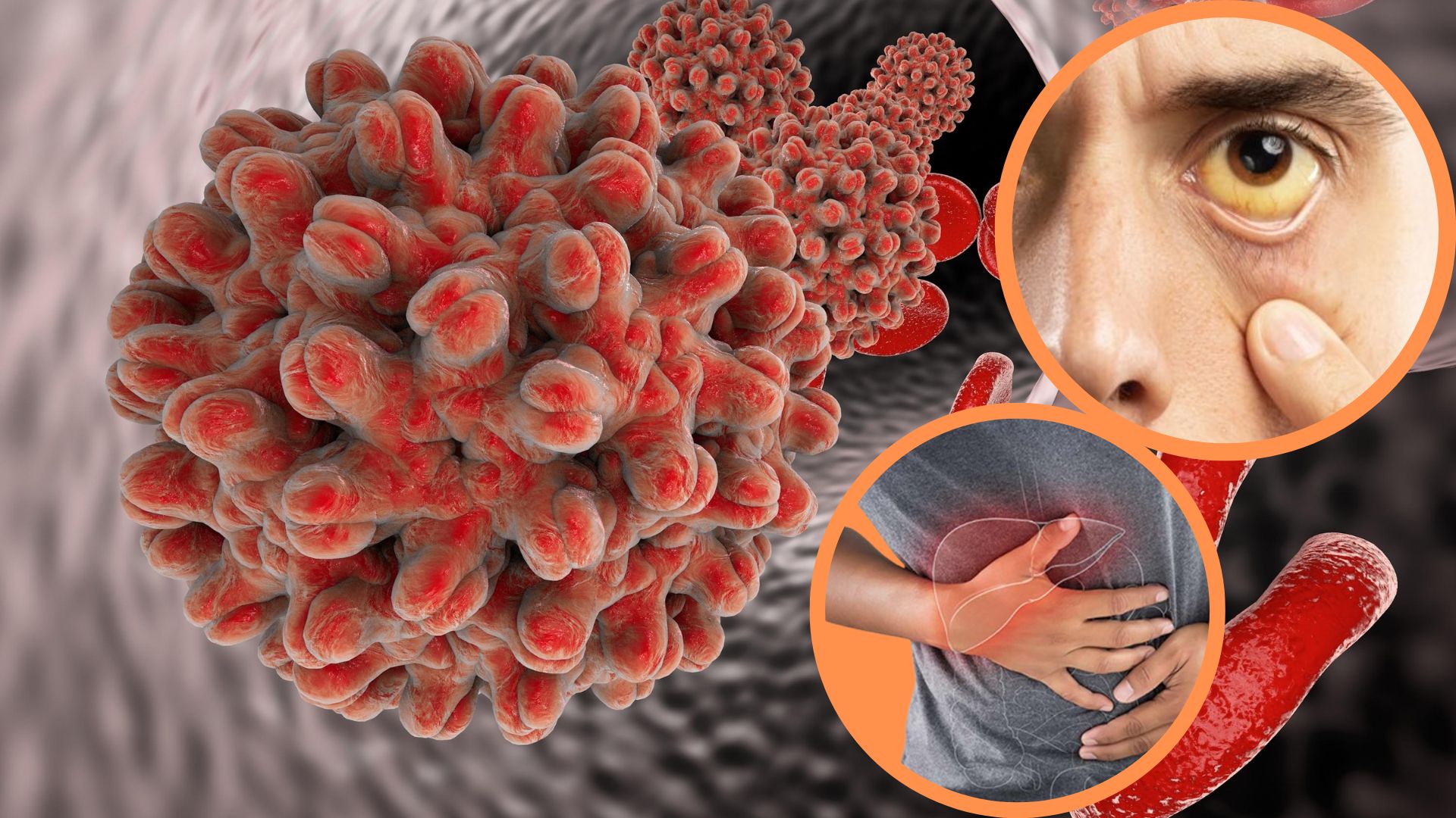 hepatitis